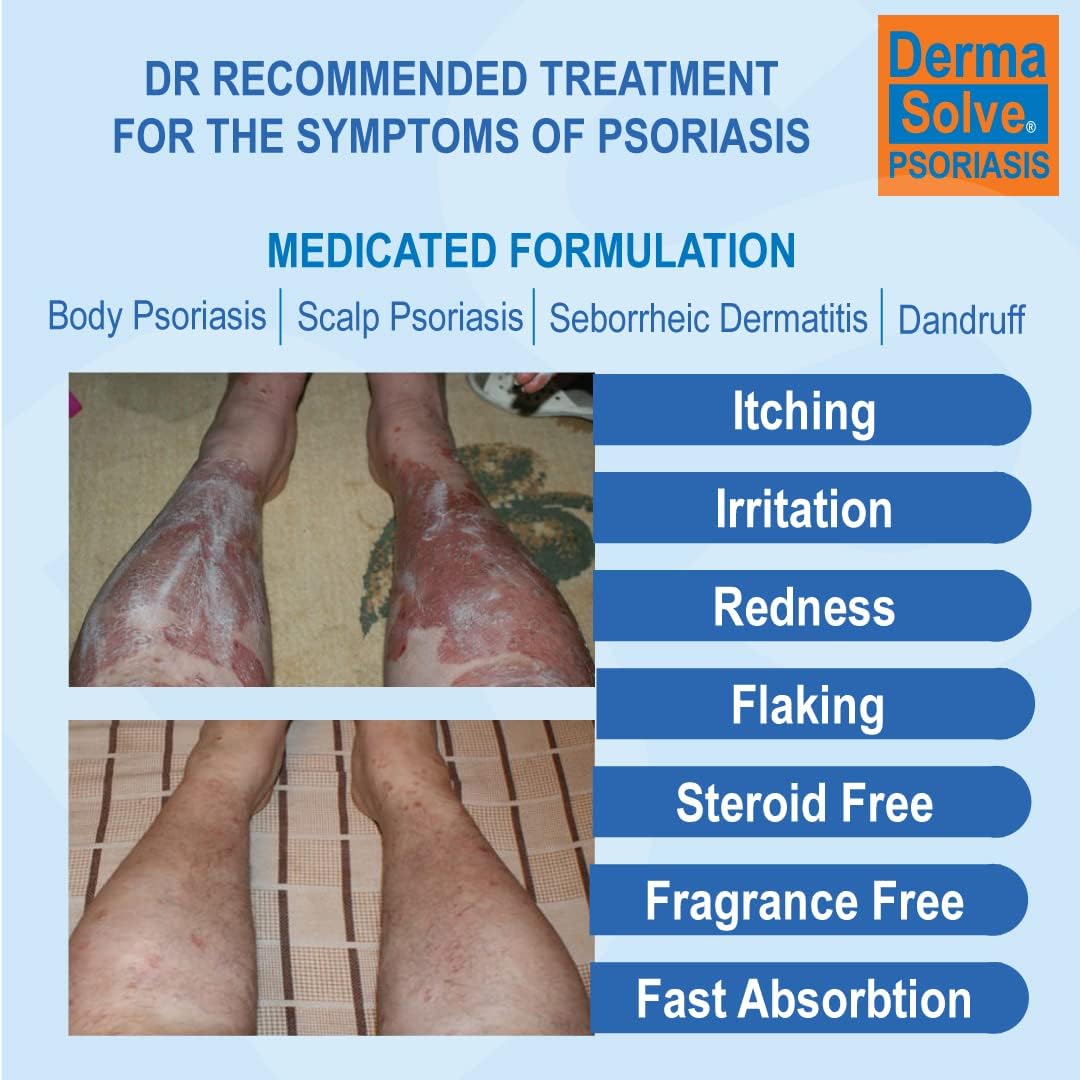 5-pack-dermasolve-psoriasis-seborrheic-dermatitis-and-dandruff-cream---soothing-relief-for-itchy-skin-with-preventative-moisturizing-formula-40-oz-2