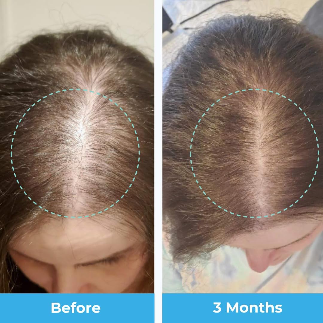 postpartum-hair-loss-support-gummies-with-biotin-collagen-folate---passion-fruit-flavored-vitamins-for-new-moms-6