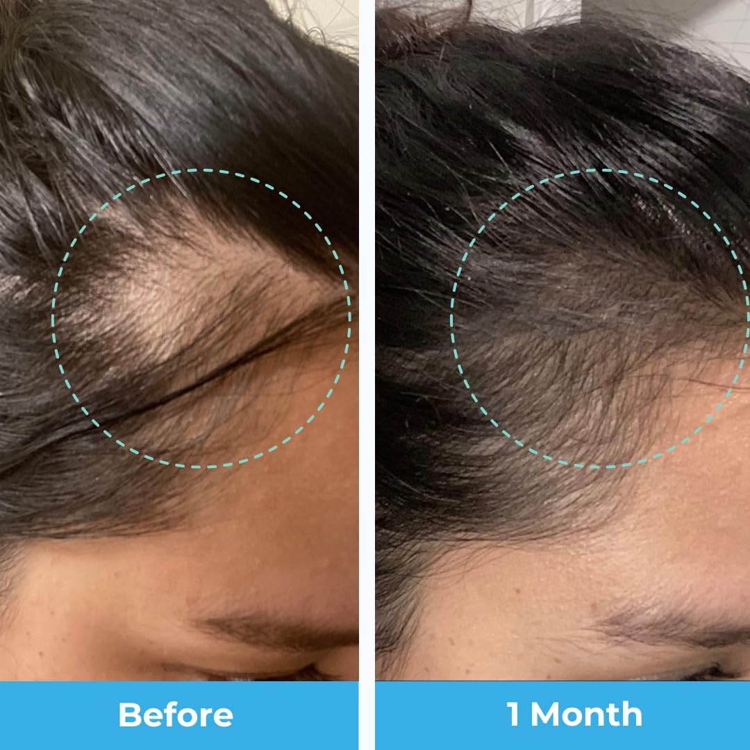 postpartum-hair-loss-support-gummies-with-biotin-collagen-folate---passion-fruit-flavored-vitamins-for-new-moms-3