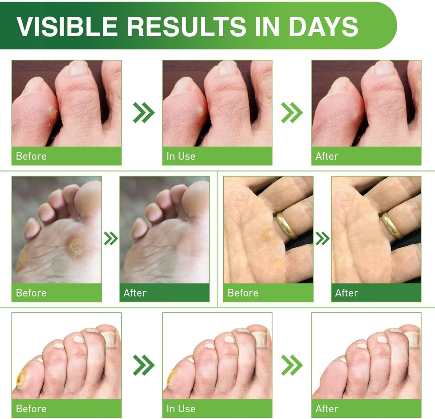 Corn Remover Pads for Feet and Toes - 30 Pack with 40% Salicylic Acid - Extra Strength Treatment for Fast Results - Medicated Bandages for Adults, Seniors, Athletes, and Workers - Espot.com.au