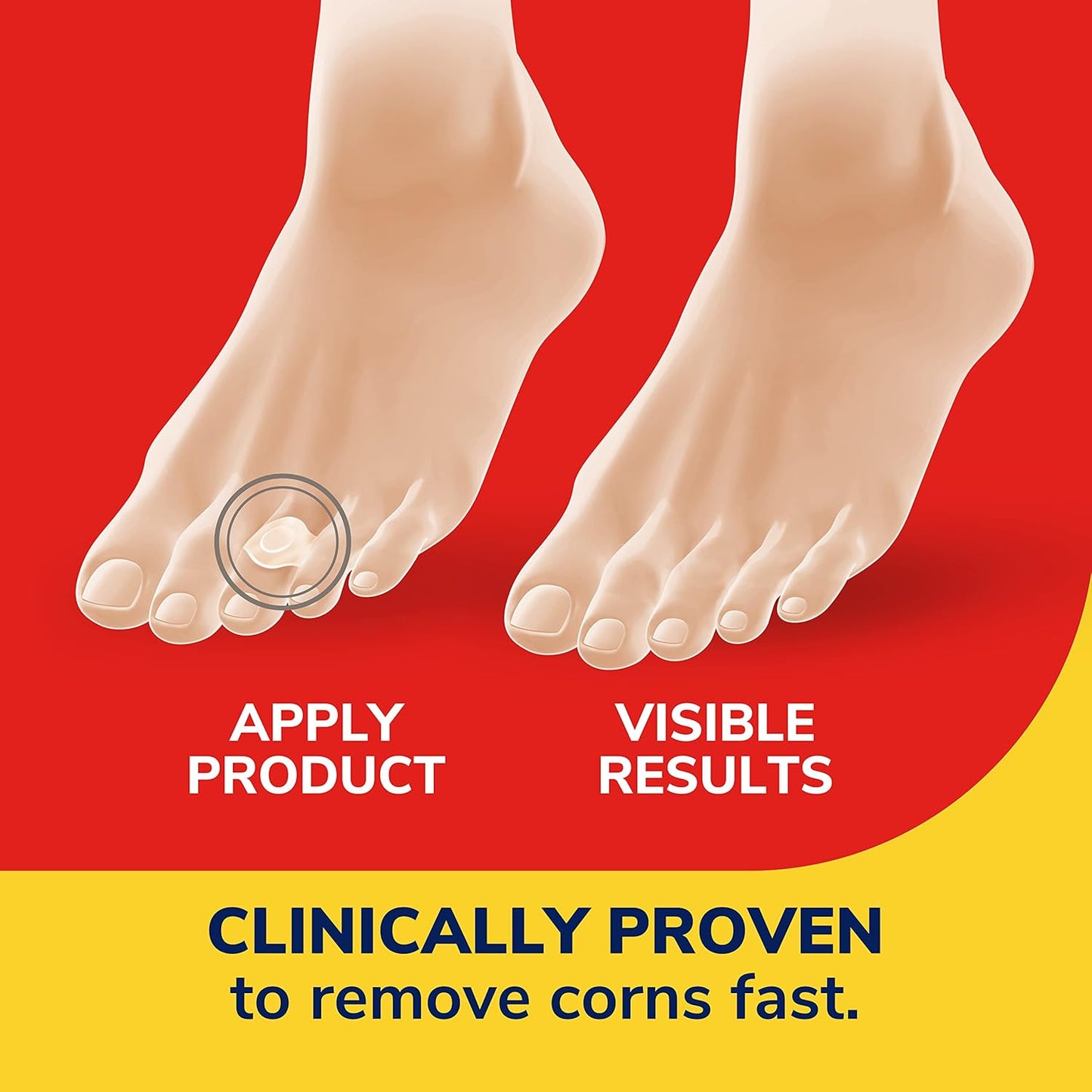 Dr. Scholl's Corn Removers with Hydrogel Technology - 6 ct for Fast Relief and Protection from Shoe Pressure - Espot.com.au