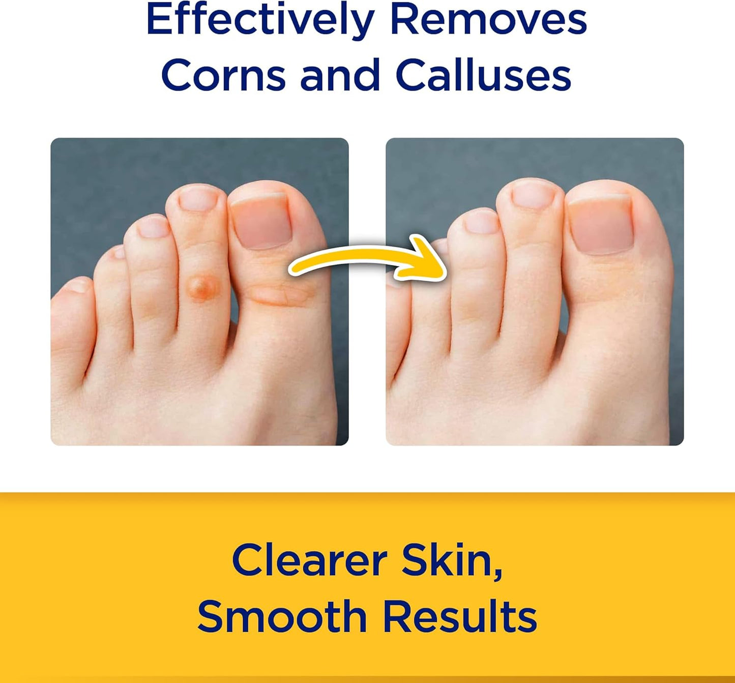 Maximum Strength Salicylic Acid Corn and Callus Remover Stick - 0.2 Oz - Espot.com.au