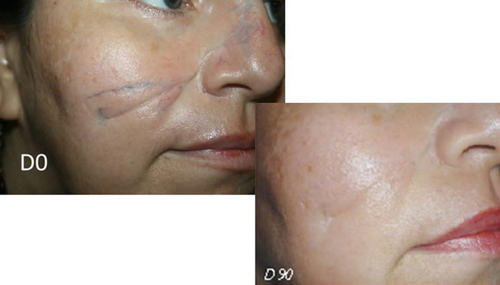 30g-sodermix-cream-for-psoriasis-and-eczema-scar-treatment-2