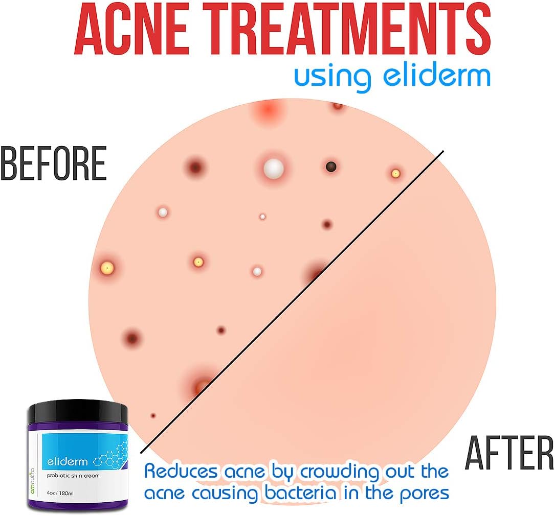 omnutra-4oz-jar-probiotic-cream-for-skin---moisturizing-lotion-with-13-strains-treats-eczema-psoriasis-cystic-acne-nail-fungus---probiotic-skin-care-4