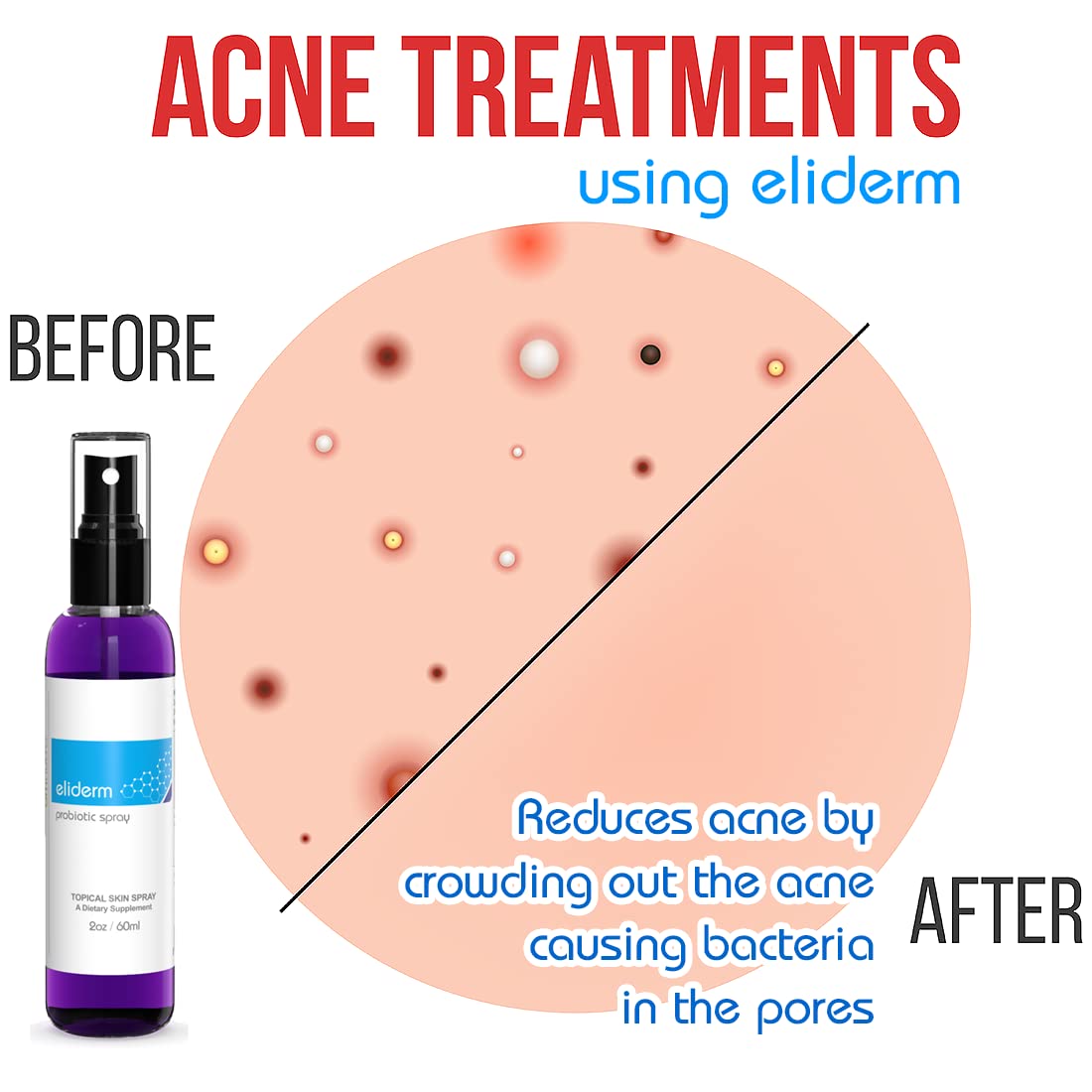 omnutra-skin-probiotic-spray---13-live-strains-for-acne-folliculitis-dermatitis-rosacea-eczema---body-face-mist-deodorant---microbiome-care-4