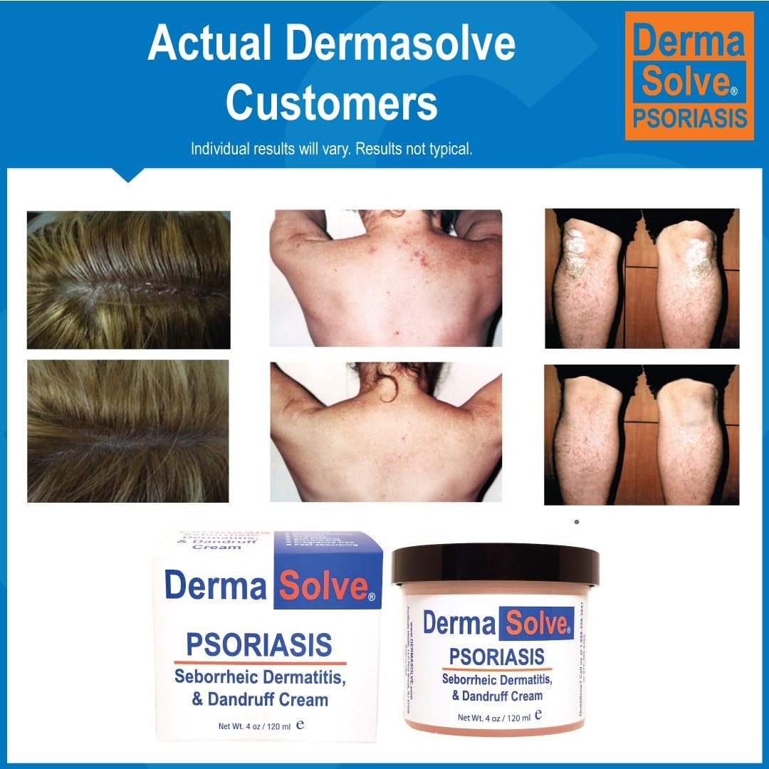 5-pack-dermasolve-psoriasis-seborrheic-dermatitis-and-dandruff-cream---soothing-relief-for-itchy-skin-with-preventative-moisturizing-formula-40-oz-5