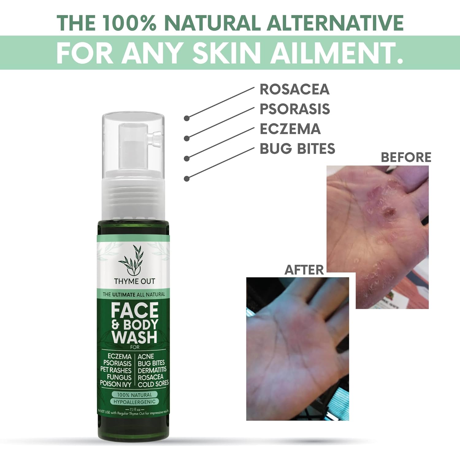 all-natural-thyme-out-face-body-wash-for-skin-conditions---eczema-psoriasis-acne-bug-bites-rosacea-and-more---soothes-itching-and-irritation---71-oz-3