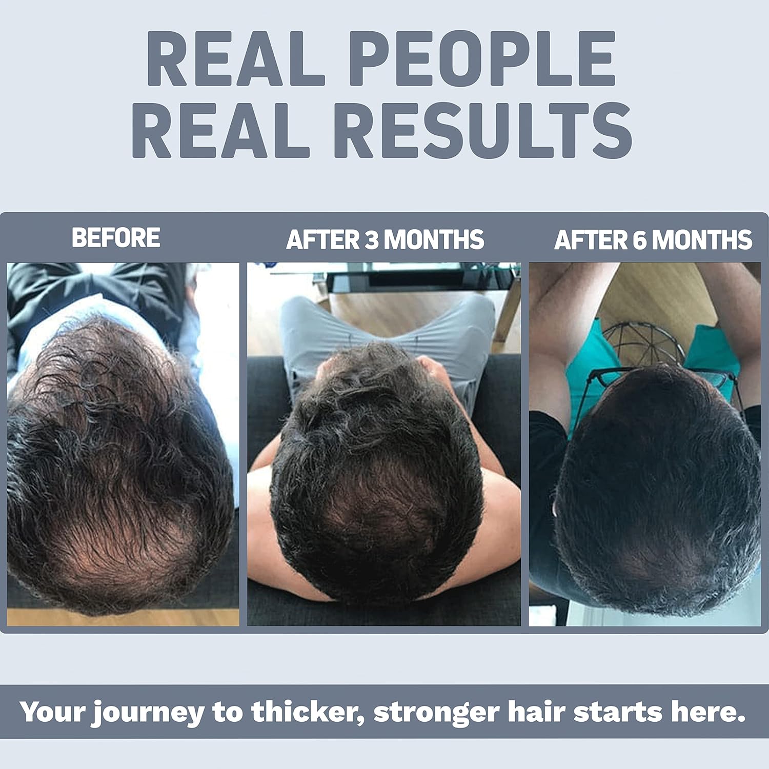 ACV Keto Gummies with The Mother, BHB & Ginseng - Hair Loss Supplement with DHT Blocker for Thinning Hair