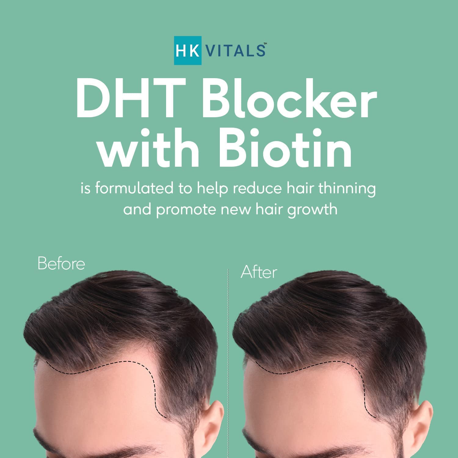 Hair Loss Supplement with DHT Blocker, Biotin, Nettle, Soya Protein - Promotes Hair Growth, Reduces Hair Fall - 60 Tablets